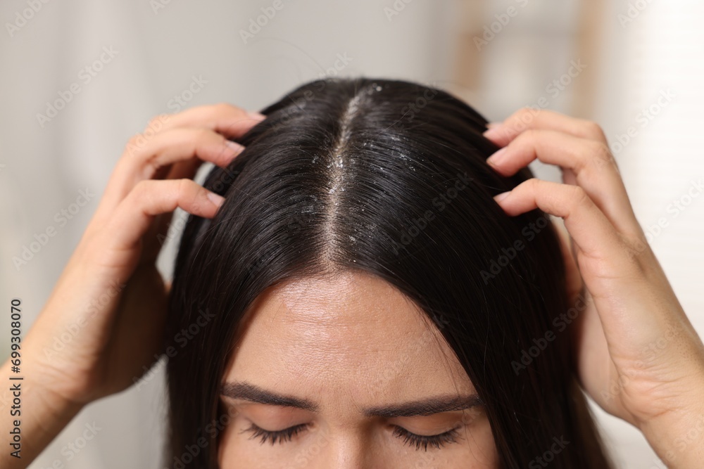 Fototapeta premium Woman examining her hair and scalp indoors, closeup. Dandruff problem