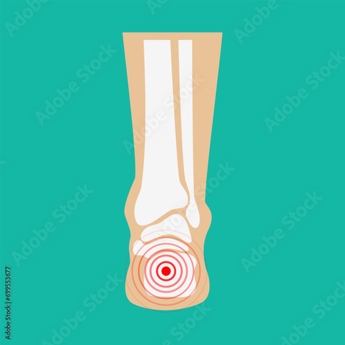 Human leg pain zones. Design elements for infographic. Vector illustration.