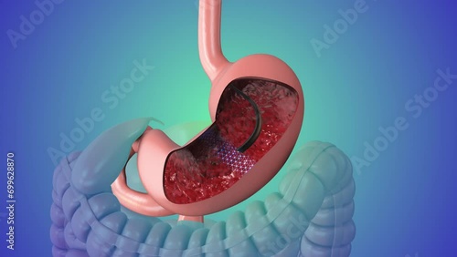 Upper gastrointestinal endoscopy medical animation photo