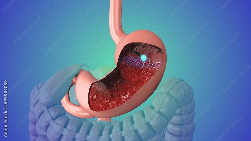 Upper gastrointestinal endoscopy medical animation - obrazy, fototapety, plakaty 