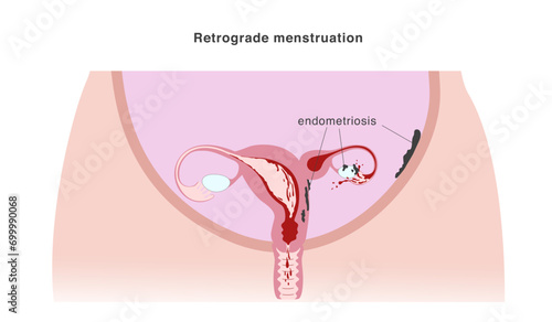Congenital malformation of uterus that isolates part of the organ and cases retrograde menstruation as one of possible reasons of endometriosis. Vector illustration photo