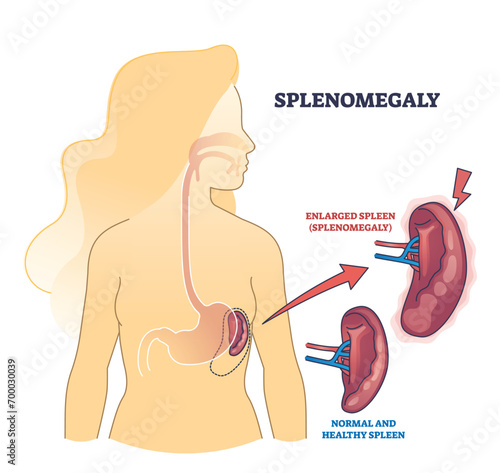 Splenomegaly symptom as enlarged spleen vs healthy organ outline diagram. Labeled educational scheme with medical condition and abdominal size of spleen caused by various diseases vector illustration