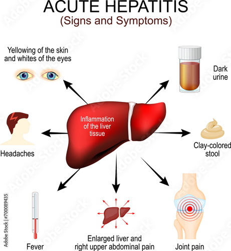 Hepatitis Symptoms