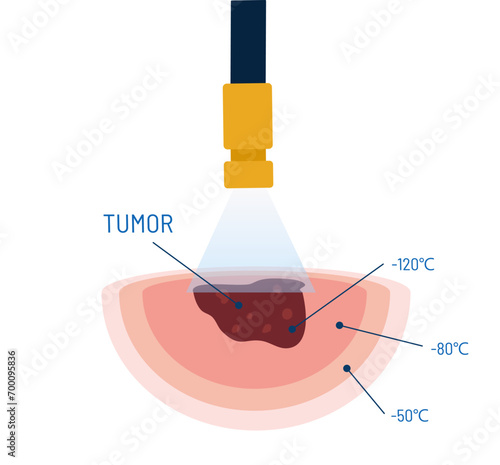 Cryosurgery procedure vector illustration. Medical instrument with cooling liquid nitrogen for tumor treatment. Cryogenic treatment. Removing mole, wart, tumor, cancer.