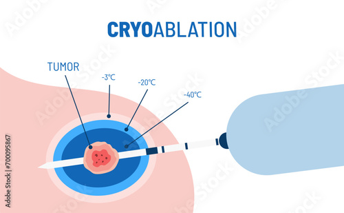 Cryoablation procedure vector illustration. Targeted medical procedure for breast cancer. Minimally invasive tumor treatment. Liquid nitrogen and cryogenic tissue ablation.