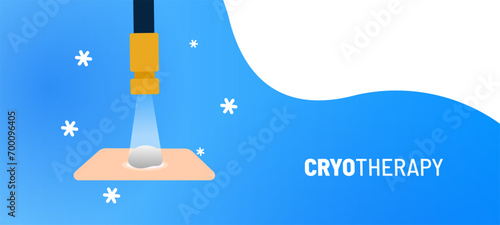 Cryosurgery procedure vector illustration. Medical instrument with cooling liquid nitrogen for tumor treatment. Cryogenic treatment. Removing mole, wart, tumor, cancer.