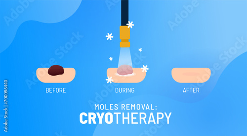 Cryotherapy process vector illustration. Removing mole, wart, tumor, cancer. Different stages of the precision cryoablation. Liquid nitrogen treatment. Targeted frozen surgery for skin health.