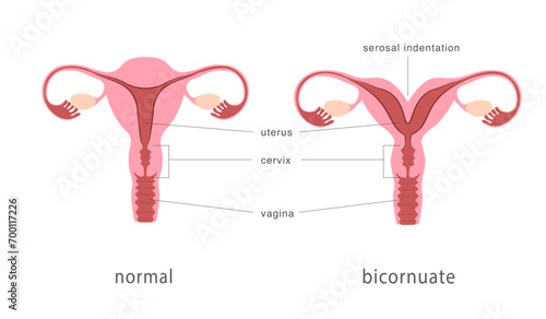 Bicornuate and normal human uterus structure. Uterine deep septum as a congenital uterine malformation. Anatomy chart. Vector illustration
