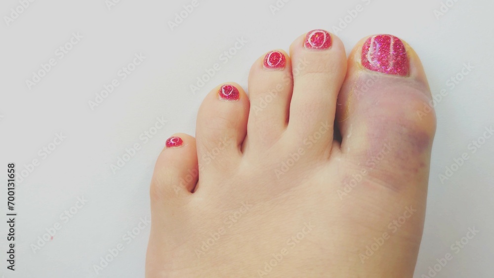 Naklejka premium contusion of the big toe, tram, bruise, cracked