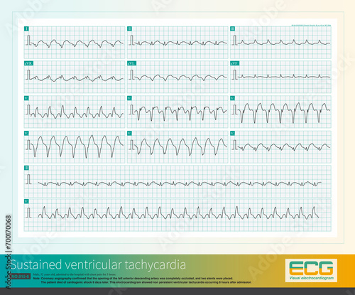 When ventricular premature contractions originate from the left ventricle, the QRS wave in lead V1 is often qR wave or notch R wave, which can be misdiagnosed as complete right bundle branch block. photo