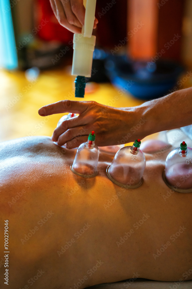 Usage of acupuncture points in a modern clinic. Woman receiving cupping treatment on back by therapist, chinese medicine treatment, health and healing concept.