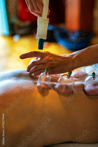 Obraz na płótnie Usage of acupuncture points in a modern clinic. Woman receiving cupping treatment on back by therapist, chinese medicine treatment, health and healing concept. w salonie