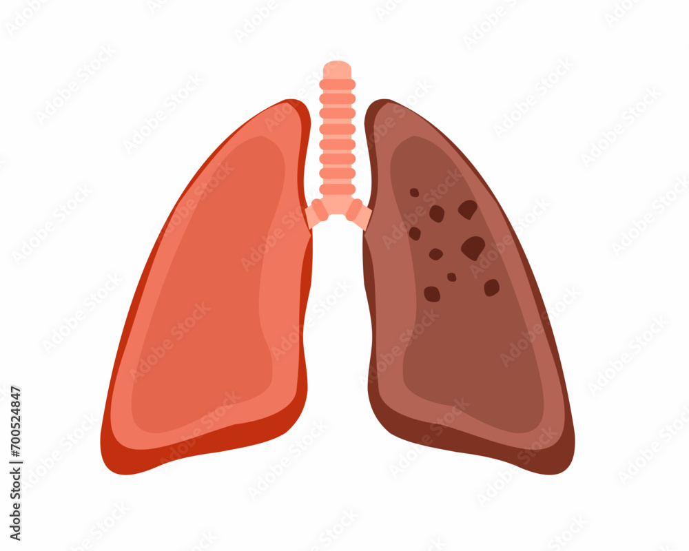 Healthy and unhealthy cancer lungs Affected human respiratory system vector illustration Healthy and unhealthy cancer lungs Affected human respiratory system vector illustration