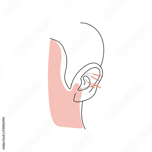 Ear of person undergoing acupuncture on white background