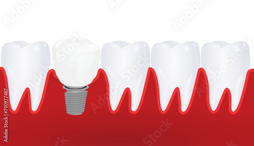 Dental implementation teeth. vector illustration