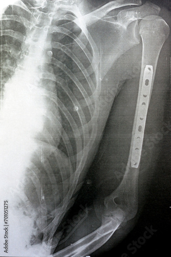 Plain x ray showing transverse midshaft left humerus fracture caused by a direct trauma in a car accident, managed by open reduction and internal fixation with plates and screws, selective focus photo