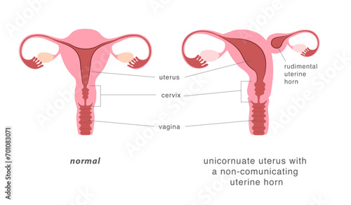 Normal human uterus and unicornuate uterus with non-comunicating uterine horn. Congenital uterine malformation anatomy diagram.