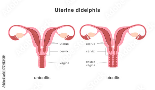 Didelphis human uterus structure of unicollis and bicollis types. Uterine deep septum as a congenital uterine malformation. Anatomy chart. photo
