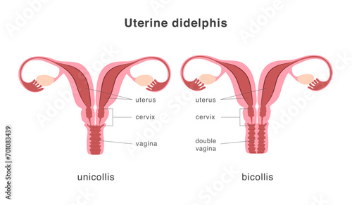 Didelphis human uterus structure of unicollis and bicollis types. Uterine deep septum as a congenital uterine malformation. Anatomy chart.