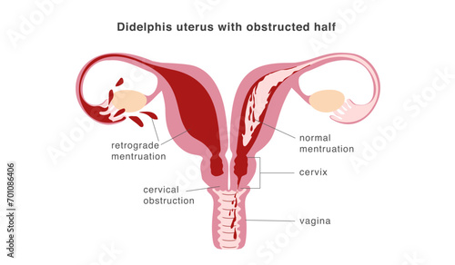 Congenital malformation of uterus isolating part of organ and causing retrograde menstruation as possible reason of endometriosis.