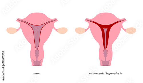 Endometrial hyperplasia in uterus medical illustration. Precancerous condition of female endometrium. photo