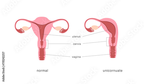 Unicornuate and normal healthy uterus comparison chart. Congenital malformation of female reproductive system.