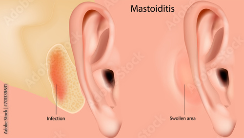 Mastoiditis. Inflammation of the mucosal lining of the mastoid antrum and mastoid air cell system inside the mastoid process. Medical illustration photo