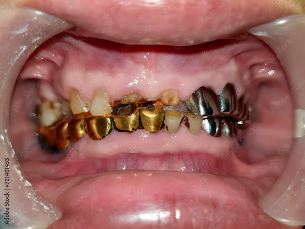 Metal crowns in mouth of Asian man. Poor oral hygiene