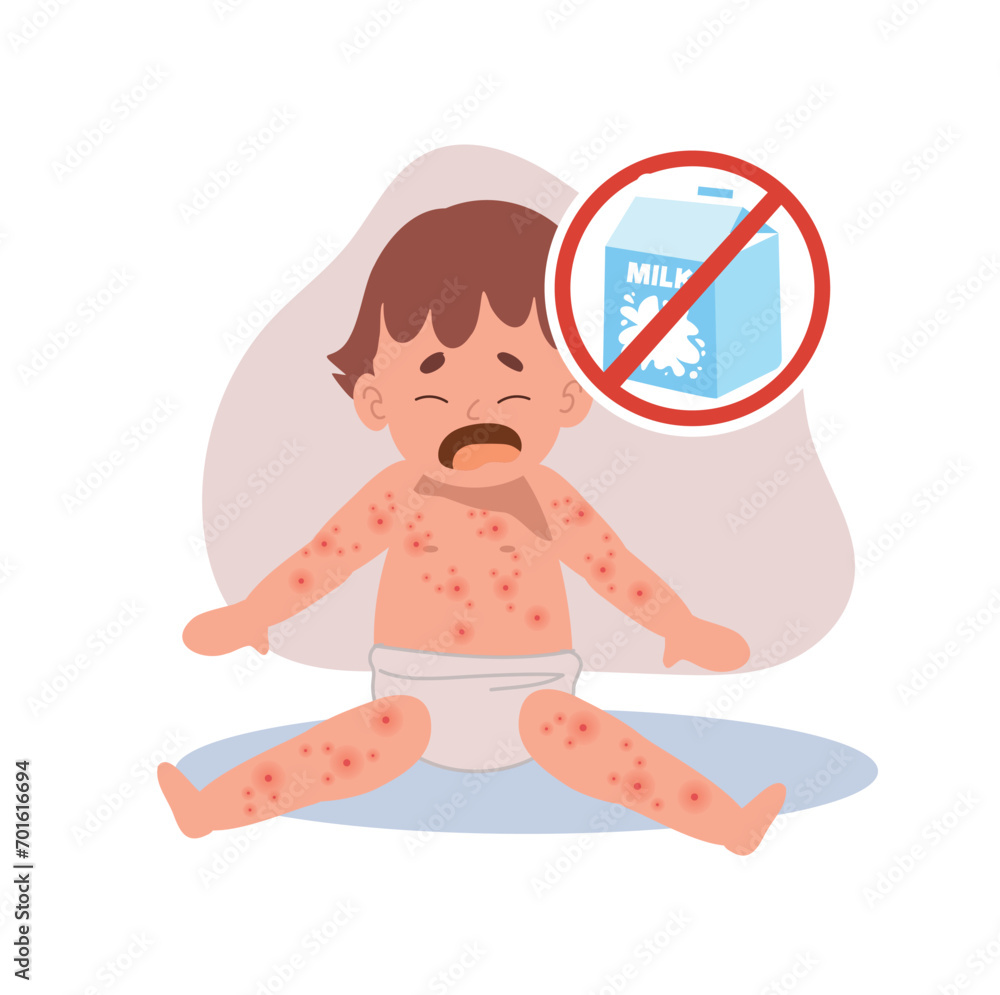 Allergic Reactions in Infants. baby with skin rash. Baby Food Allergy