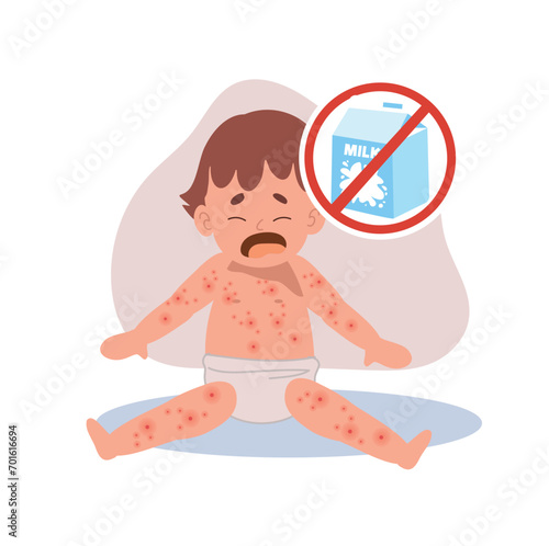 Allergic Reactions in Infants.  baby with skin rash. Baby Food Allergy from lactose milk . milk free
