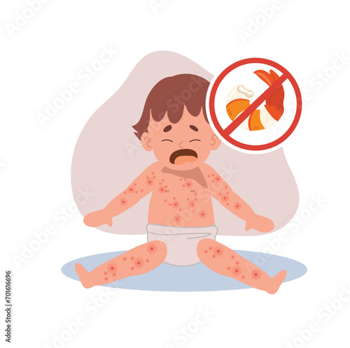 Allergic Reactions in Infants.  baby with skin rash. Baby Food Allergy from seafood or shellfish . shrimp free