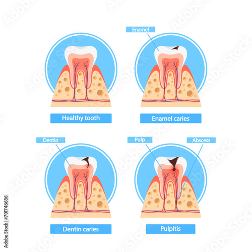 Caries Stages Infographics. Healthy Tooth, Enamel Caries, Dentin Caries, and Pulpitis Cross Section View, Medical Visual