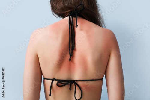 Foto Allergic young woman with sunburned skin on blue background, back view