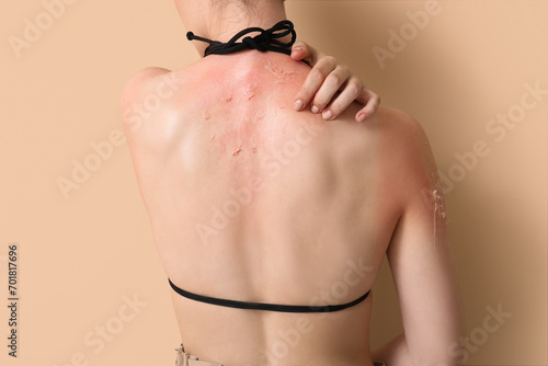 Allergic young woman with sunburned skin on beige background, back view photo