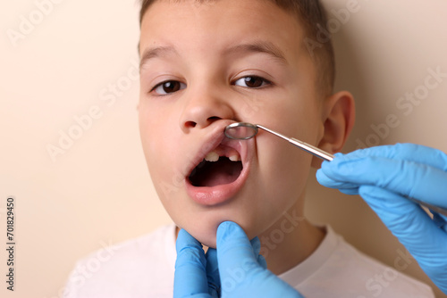 The doctor examines the oral cavity of a child with a missing tooth using a dental mirror. Healthcare and dental care concept. photo