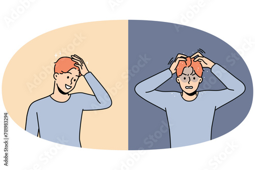 Set of young man suffer from dandruff versus excited with clean healthy hair after treatment. Concept of medical or beauty procedures for haircare. Vector illustration.