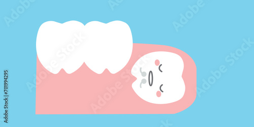 歯茎に埋没した歯 親知らずのイラスト