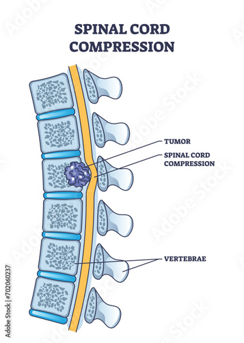 Spinal cord compression with tumor and vertebrae condition outline diagram. Painful back cause with medical problem explanation vector illustration. Skeleton pathology and unhealthy skeletal position