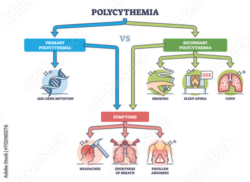 Polycythemia or erythrocytosis as red cells overproduction and increased blood mass outline diagram. Labeled educational scheme with primary, secondary disease stages and symptoms vector illustration