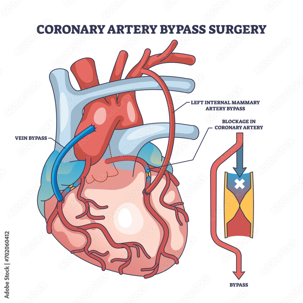 Coronary artery bypass surgery for blocked blood flow outline diagram