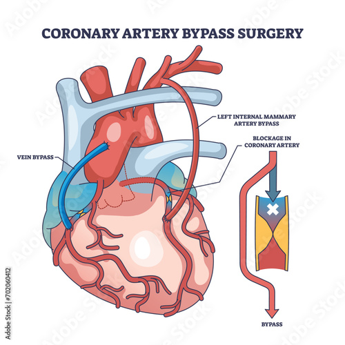 Coronary artery bypass surgery for blocked blood flow outline diagram. Labeled educational scheme with heart procedure and cardiology condition vector illustration. Medical cardiovascular treatment.