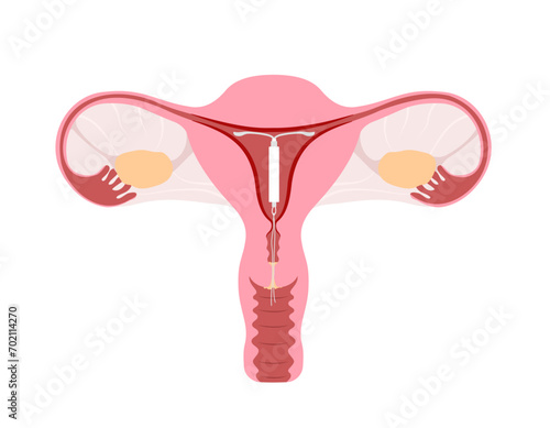 Intrauterine device with hormone capsule inside the uterus. Hormonal IUD for women contraception.