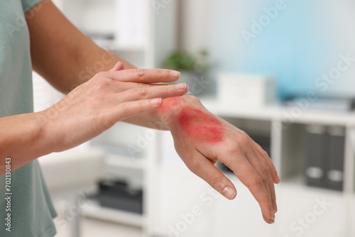 Woman applying healing cream onto burned hand indoors, closeup photo