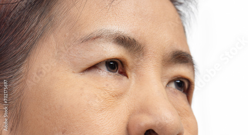 The ptosis or droopy eyelids in asian senior woman.. photo