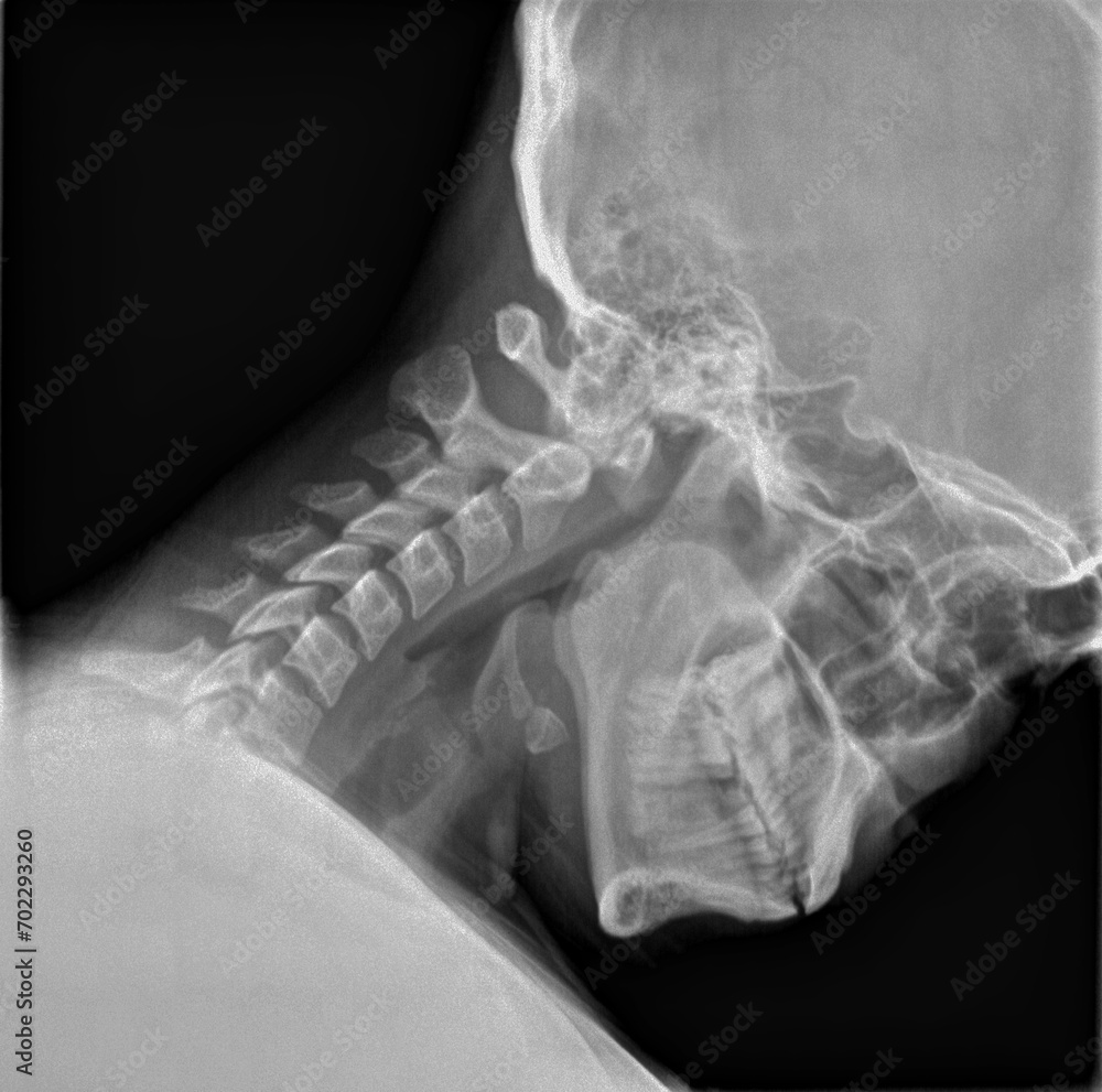 Normal film xray or radiograph of a cervical neck. Lateral flexion view ...