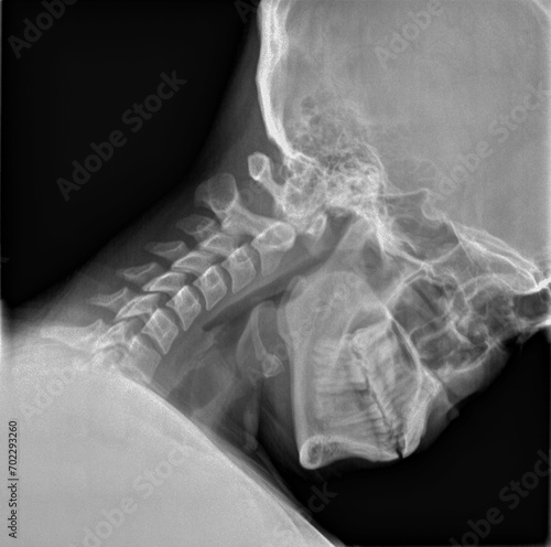 Normal film xray or radiograph of a cervical neck. Lateral flexion view which is the best way to see Spondylolisthesis and to assess for spinal and ligament stability particularly after an injury