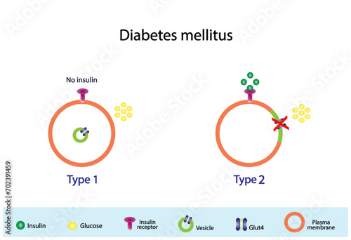 Diabetes mellitus type 1, pancreas's failure to produce enough insulin and type 2, cells fail to respond to insulin (Insulin resistance). Result in high blood glucose levels. Vector illustration