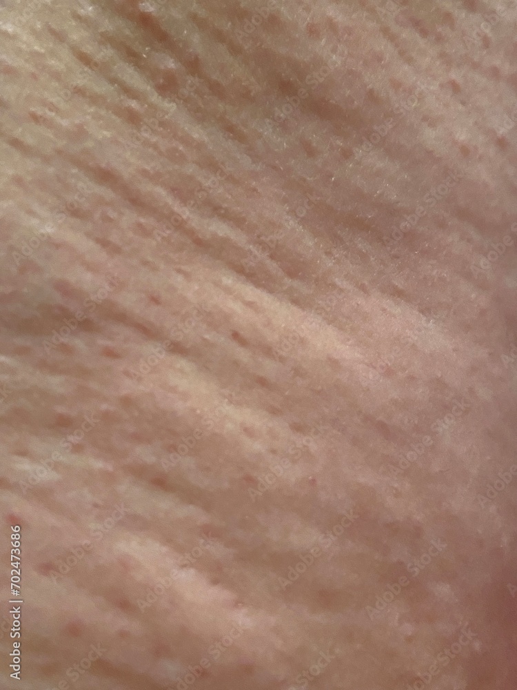 cellulite texture skin background surface with cellulite skin showing lumps and bumps