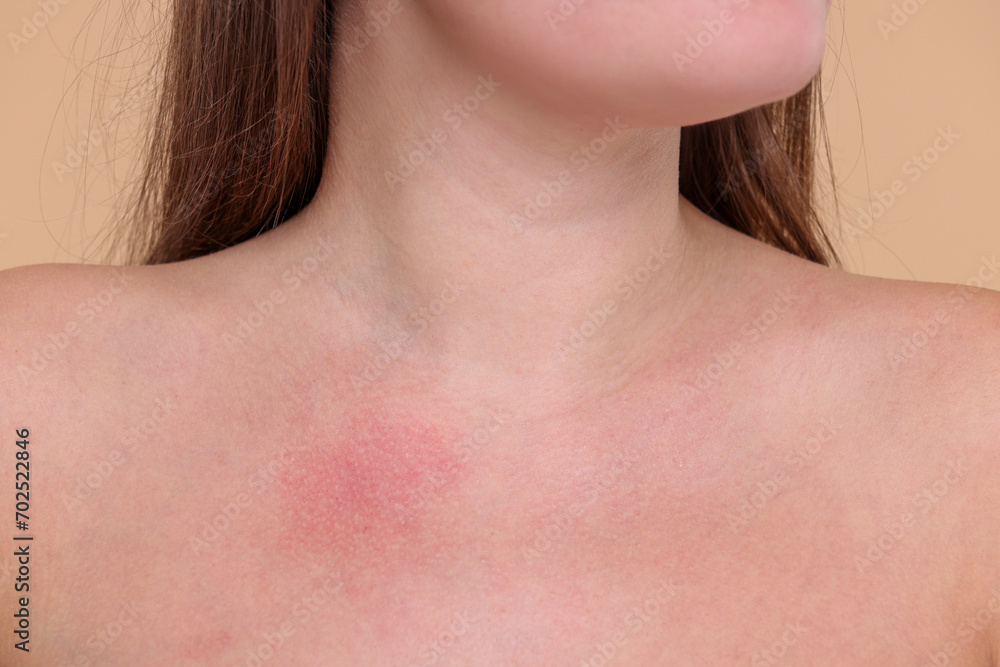Closeup view of woman with reddened skin on her collarbone against beige background Closeup view of woman with reddened skin on her collarbone against beige background