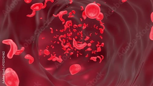 Sickle Cell Anemia In Blood Vessel